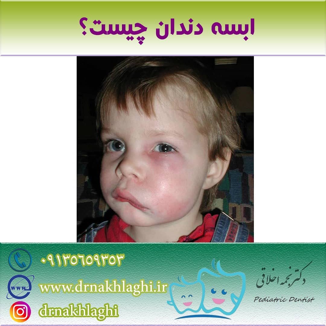 آبسه دندان چیست؟