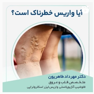 آیا واریس خطرناک است؟