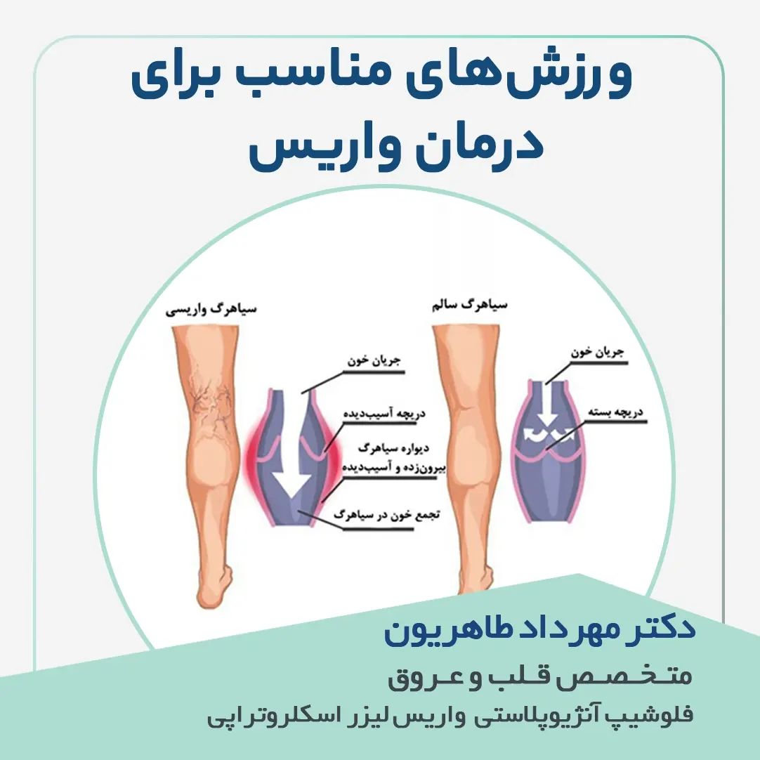 ورزش های مناسب برای درمان واریس