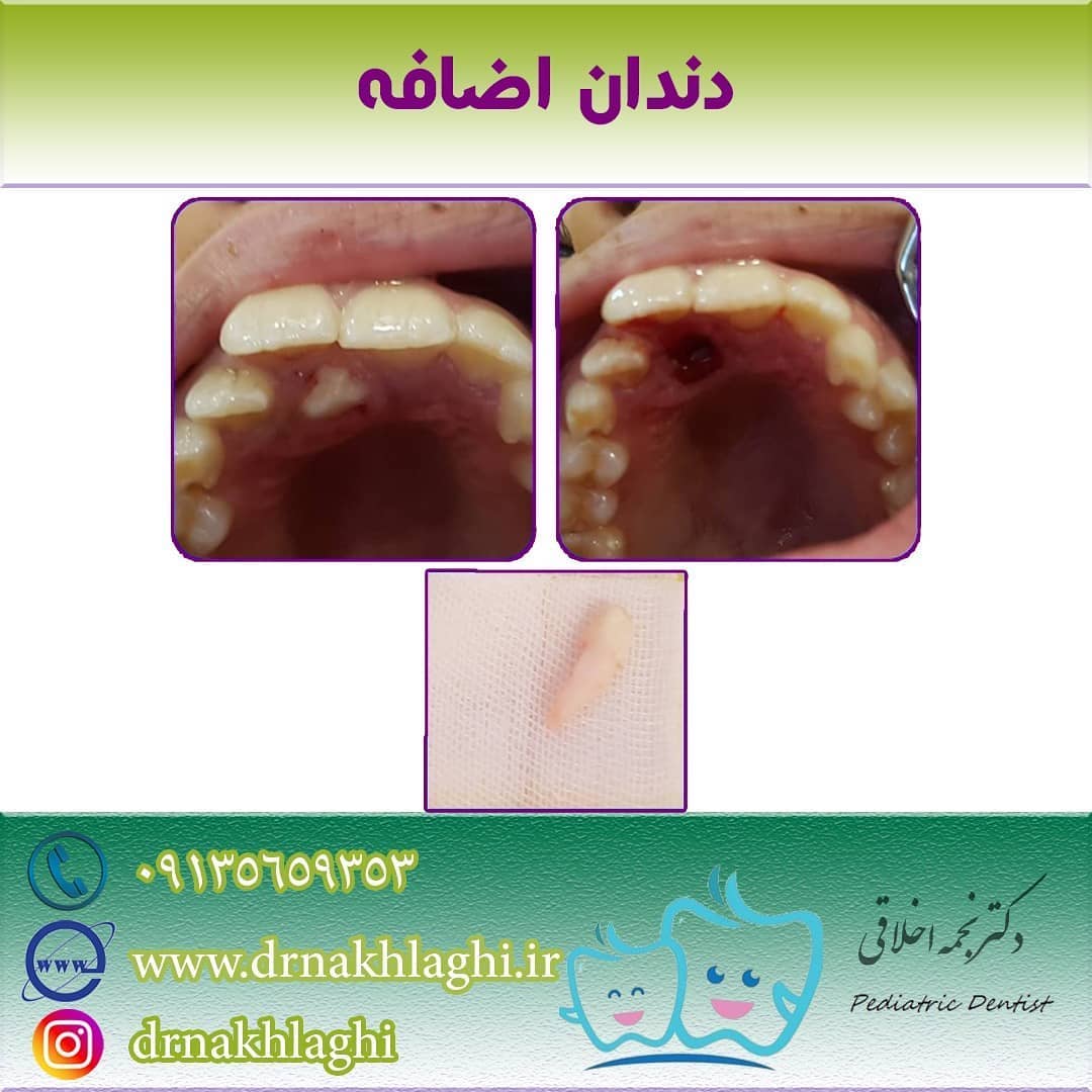 علل در آوردن دندان اضافه