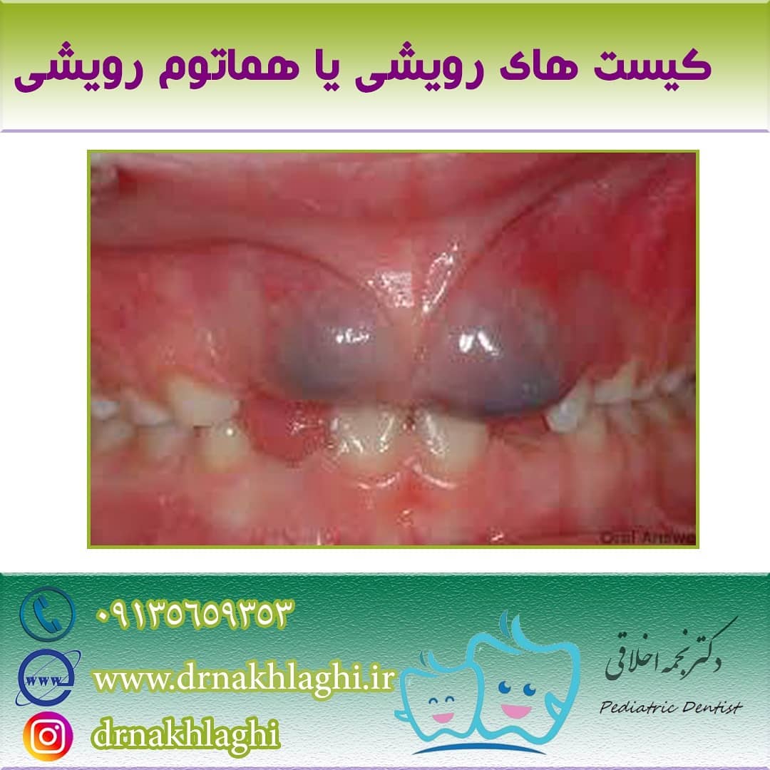 کیست های رویشی یا هماتوم رویشی