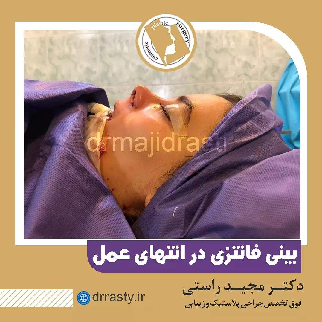 نمونه ای از یک بینی فانتزی در انتهای عمل