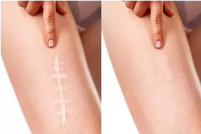 تزریق کورتون در اسکار