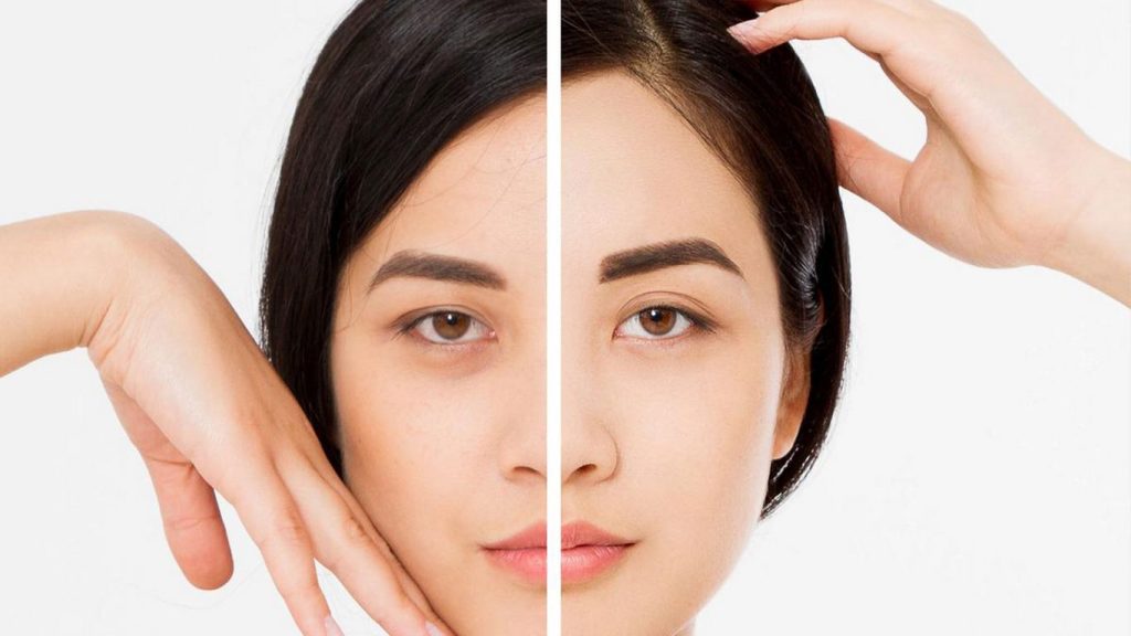 فیلر شقیقه اولترارووفیل