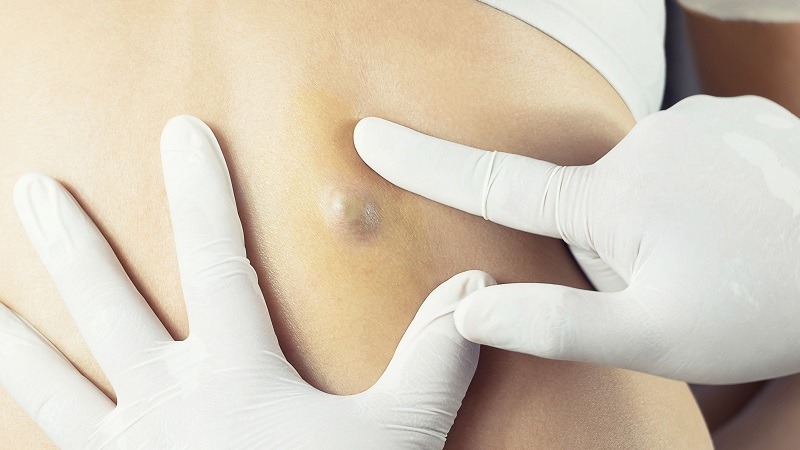 جراحی کیست سباسه بزرگ