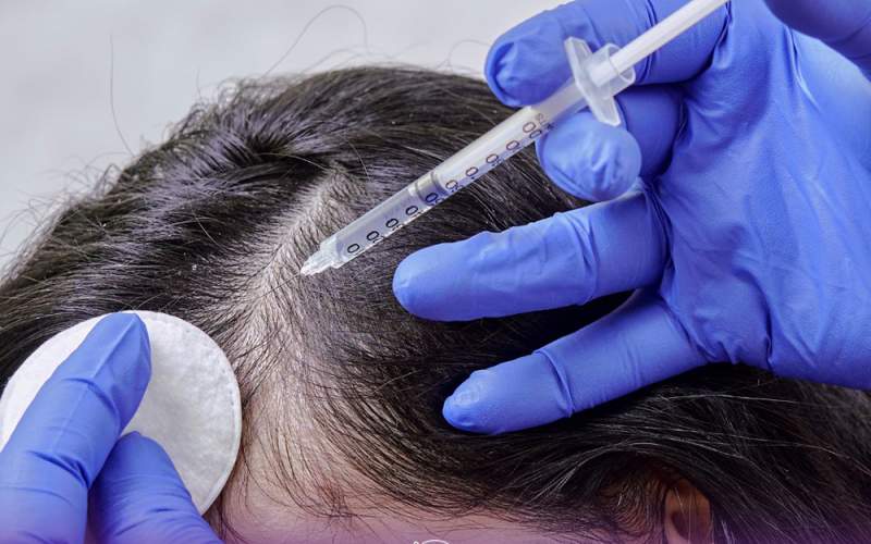 مزو رویش مو